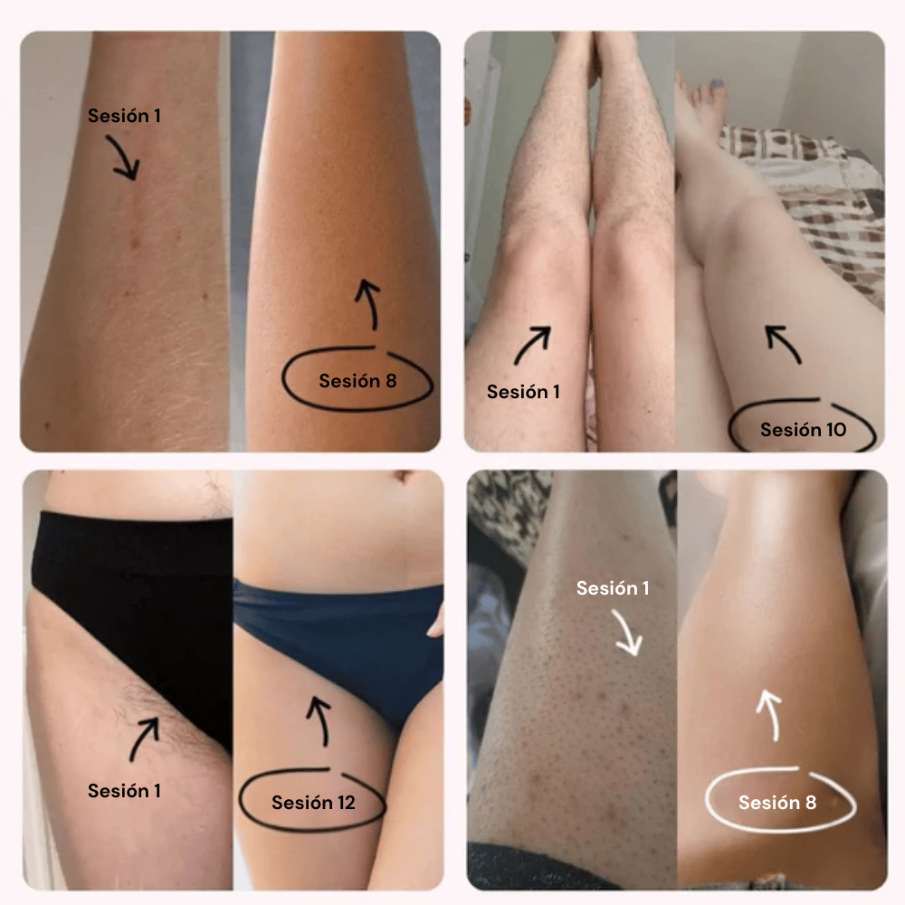 Ephra Cosmetics • Depiladora IPL de Luz Pulsada